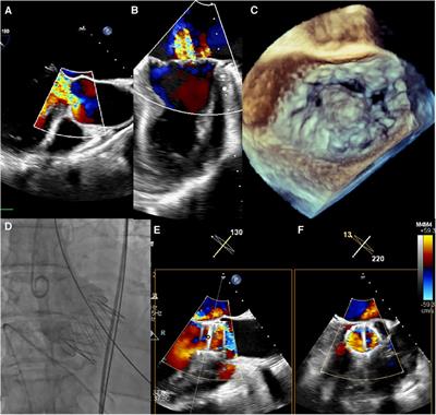 Simultaneous management of aortic and mitral regurgitation through one-stage transcatheter aortic valve replacement and transcatheter edge-to-edge repair: case report